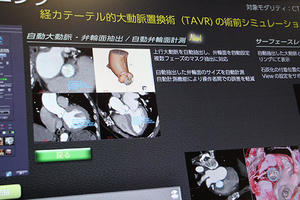 ボリュームデータから自動で弁輪面の抽出と計測が行える