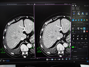 レトロスペクティブに適用できる「統計的CT画像ノイズ低減機能」（W.I.P.）