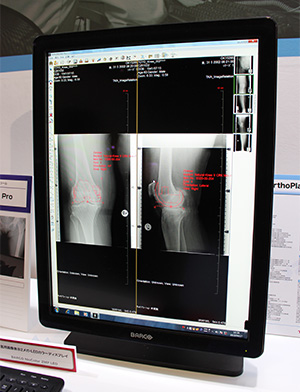 OrthoPlanner Proの新機能