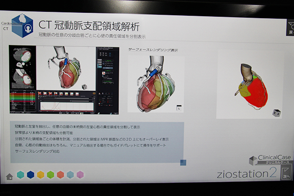 任意の血管が支配する灌流心筋量を解析する「CT冠動脈支配領域解析」