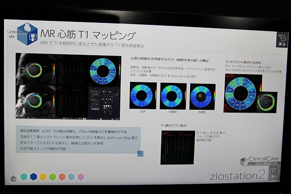 びまん性繊維化の定量解析が可能な「MR心筋T1マッピング」