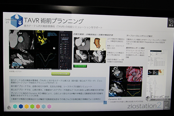 レポート機能などが強化された「TAVR術前プランニング」