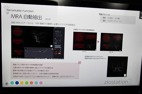 頭部MRAの作成を支援する“MRA自動抽出”
