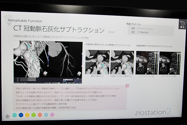 正確な石灰化除去を可能にする“CT冠動脈石灰化サブトラクション”