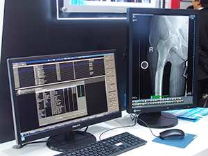 整形外科用PACSの「iRad-OT」