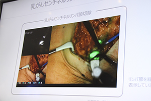 センチネルリンパ節が蛍光表示され同定が容易になる。