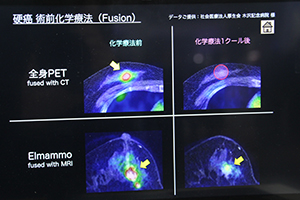 全身PETではわからない化学療法後の残存腫瘍も検出可能