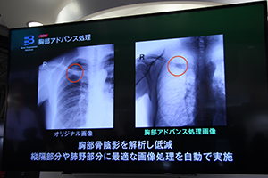 胸部アドバンス処理（Bone Suppression Advance）