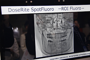 DoseRite SpotFluoroの“SPOT ROI”モード