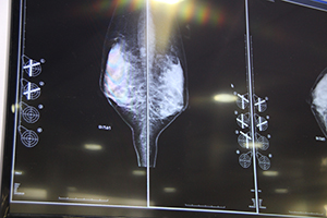 マンモグラフィと超音波の併用検診をサポートする“Echo Scan Guide”