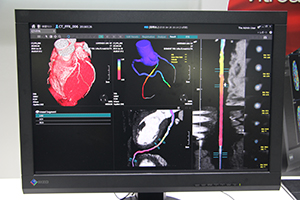 CTデータからVitreaでFFR-CT計測が可能な機能を紹介（画面は開発中のもの）