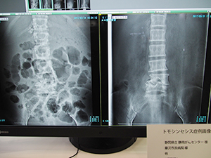 トモシンセシスの症例画像：腰椎骨折