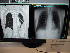 トモシンセシスの症例画像：播種による癌性胸膜炎