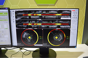 IVUS/OCT解析システム「CAAS IntraVascular」に搭載された“NIRS解析”