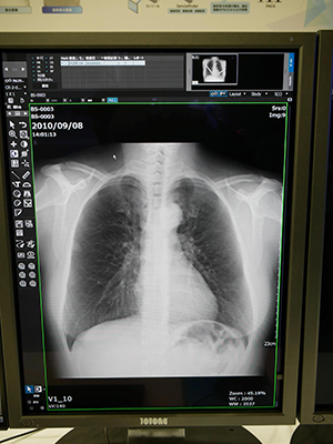 骨を除去して病変を見つけやすくする“Bone Suppression処理”