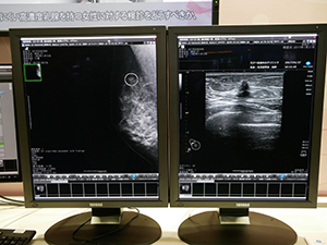 乳がん検診での診断を支援する「NEOVISTA I-PACS CAD typeM」