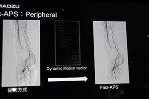 DSAのアーチファクトを自動補正する“Flex-APS”（W.I.P.）