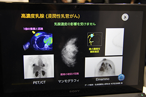 デンスブレストでも影響を受けずに微小腫瘍を確認できた例。