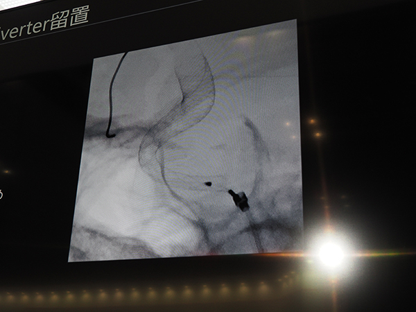 動脈瘤内のコイルの状態やステントのメッシュまで確認可能