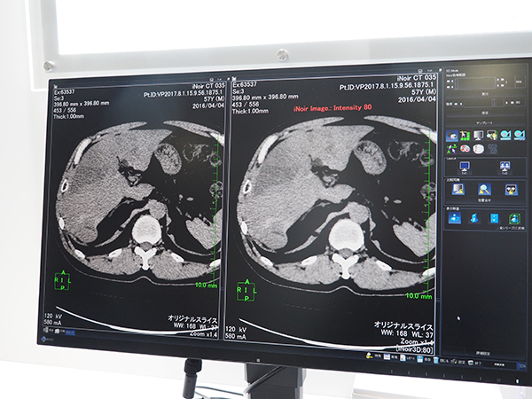 DICOM画像からノイズ低減できるAZE VirtualPlace iNoir