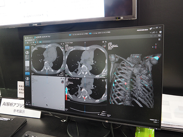 骨転移の解析を行う“Bone Subtraction Analysis”（W.I.P.）を参考展示