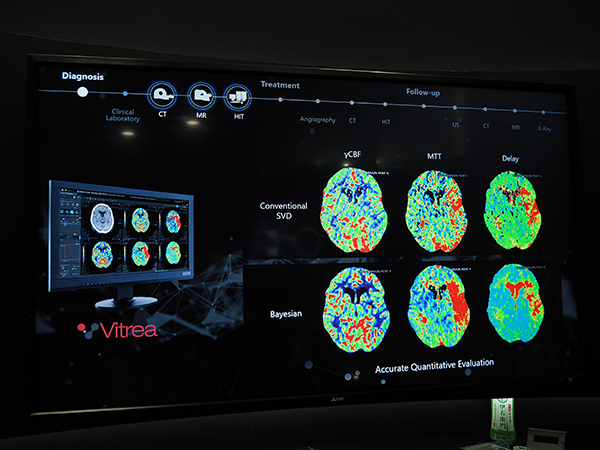 急性期脳梗塞のクリニカルサイクルの中で診断を支援する4D-perfusionなどアプリケーションを紹介