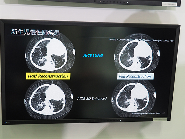 ディープラーニングを用いた画像再構成技術“AiCE”では小児の撮影でHalf再構成画像でフル再構成との比較画像を掲示。遜色ない画質が得られている。