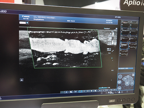 33MHz超高周波とmSMIでの静脈弁の描出