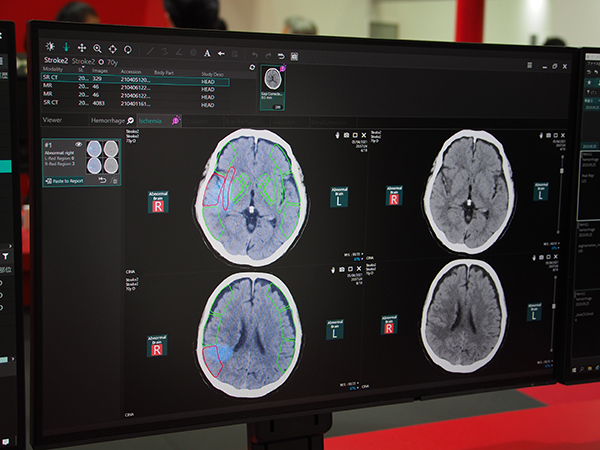 Abierto RSSのIschemia analysis”