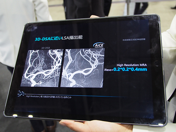 DLR-MRI（AiCE）で従来は難しかった頭頸部のLSAを非造影で描出