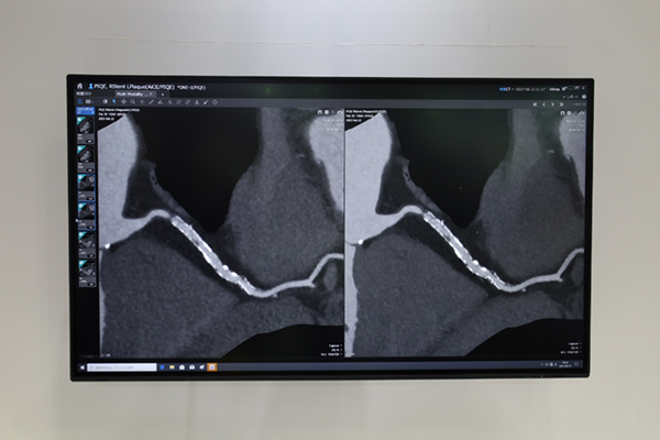 超解像DLRのPIQEによりADCTで撮影した冠動脈ステントの描出能が向上