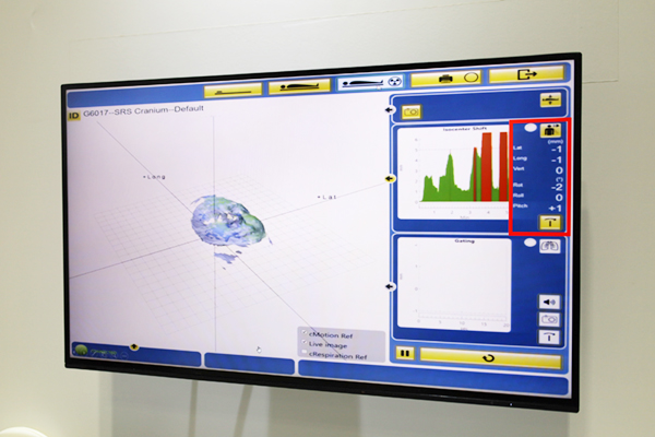 光学式体表面トラッキングシステム「Catalyst+」で体表面をモニタリングして高精度の治療を実施