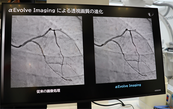 リアルタイム画像処理「αEvolve Imaging」で透視像のノイズを抑制