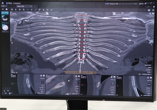 一目で骨折箇所を確認し，自動ラベリングでレポート作成も支援する「Open Rib」