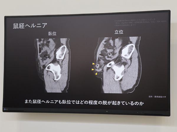 鼠径ヘルニアや脱膀胱,腰椎すべり症など,立位で症状が現れる疾患への応用が期待される。 鼠径ヘルニアや脱膀胱,腰椎すべり症など,立位で症状が現れる疾患への応用が期待される。