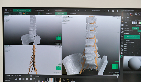 椎体のBone Imageにおける骨抽出機能 椎体のBone Imageにおける骨抽出機能