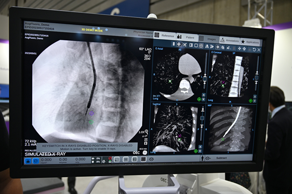 透視画像にCBCT画像が追従して手技を支援する「Lung Suite」 透視画像にCBCT画像が追従して手技を支援する「Lung Suite」