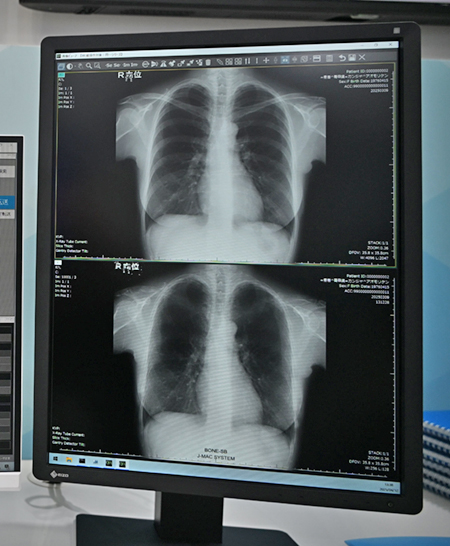 「iRad-QA」に標準搭載される「肋骨減弱」機能はAI技術で骨と重なる結節などの視認性を向上 「iRad-QA」に標準搭載される「肋骨減弱」機能はAI技術で骨と重なる結節などの視認性を向上
