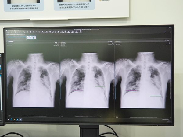 現在開発中の「横隔膜同定技術」 現在開発中の「横隔膜同定技術」