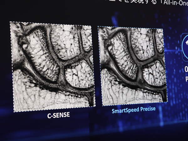MRIの高速化と高画質化を革新する「SmartSpeed Precise」(右) MRIの高速化と高画質化を革新する「SmartSpeed Precise」(右)