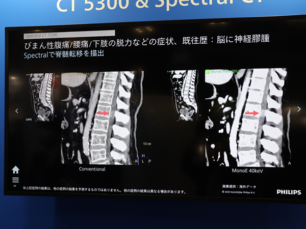 「Spectral CT 7500」のスペクトラルイメージングにより脊髄転移を明瞭化 「Spectral CT 7500」のスペクトラルイメージングにより脊髄転移を明瞭化