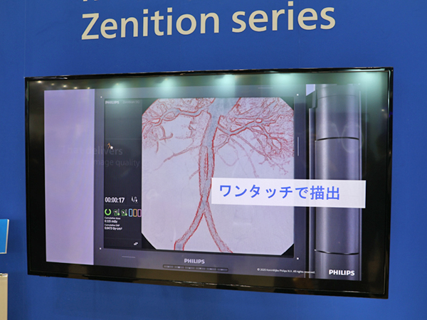 ワンタッチで透視像の血管壁を抽出する「Auto Vascular Outline」 ワンタッチで透視像の血管壁を抽出する「Auto Vascular Outline」