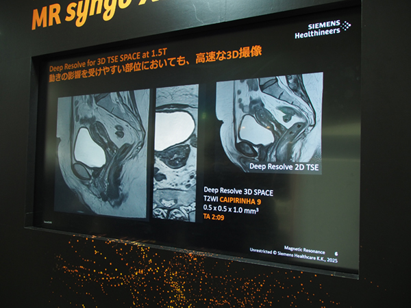 Deep Resolveと3D SPACE,CAIPIRINHAを組み合わせて高速な3D撮像を実現 Deep Resolveと3D SPACE,CAIPIRINHAを組み合わせて高速な3D撮像を実現