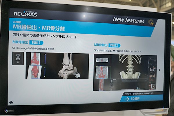 MR骨抽出ではCT like Imageからワンクリックで骨の自動抽出が可能 MR骨抽出ではCT like Imageからワンクリックで骨の自動抽出が可能