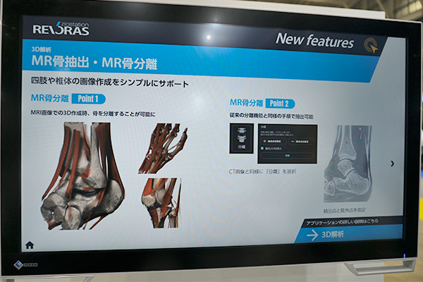 MR骨分離ではMR画像から3D作成時に骨の分離が可能 MR骨分離ではMR画像から3D作成時に骨の分離が可能