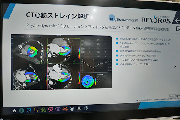 心筋の動態評価を可能にするCT心筋ストレイン解析(W.I.P.) 心筋の動態評価を可能にするCT心筋ストレイン解析(W.I.P.)