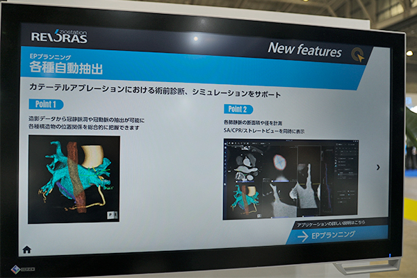 アブレーションの術前診断・シミュレーションに必要な構造物を抽出して手技を支援 アブレーションの術前診断・シミュレーションに必要な構造物を抽出して手技を支援