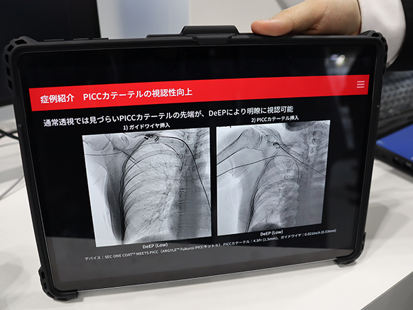 透視画像処理技術「DeEP」による末梢留置型中心静脈カテーテル（PICC）の視認性向上