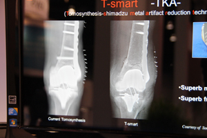 従来のトモシンセシス（左）と“T-smart”（右）の比較。T-smartの方が，金属辺縁の描出に優れ，奥の金属の写り込みがなくなり骨折線の観察が容易になるといったメリットがある。
