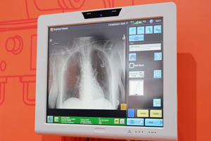 Chest Bone Suppressionを適用した骨除去画像